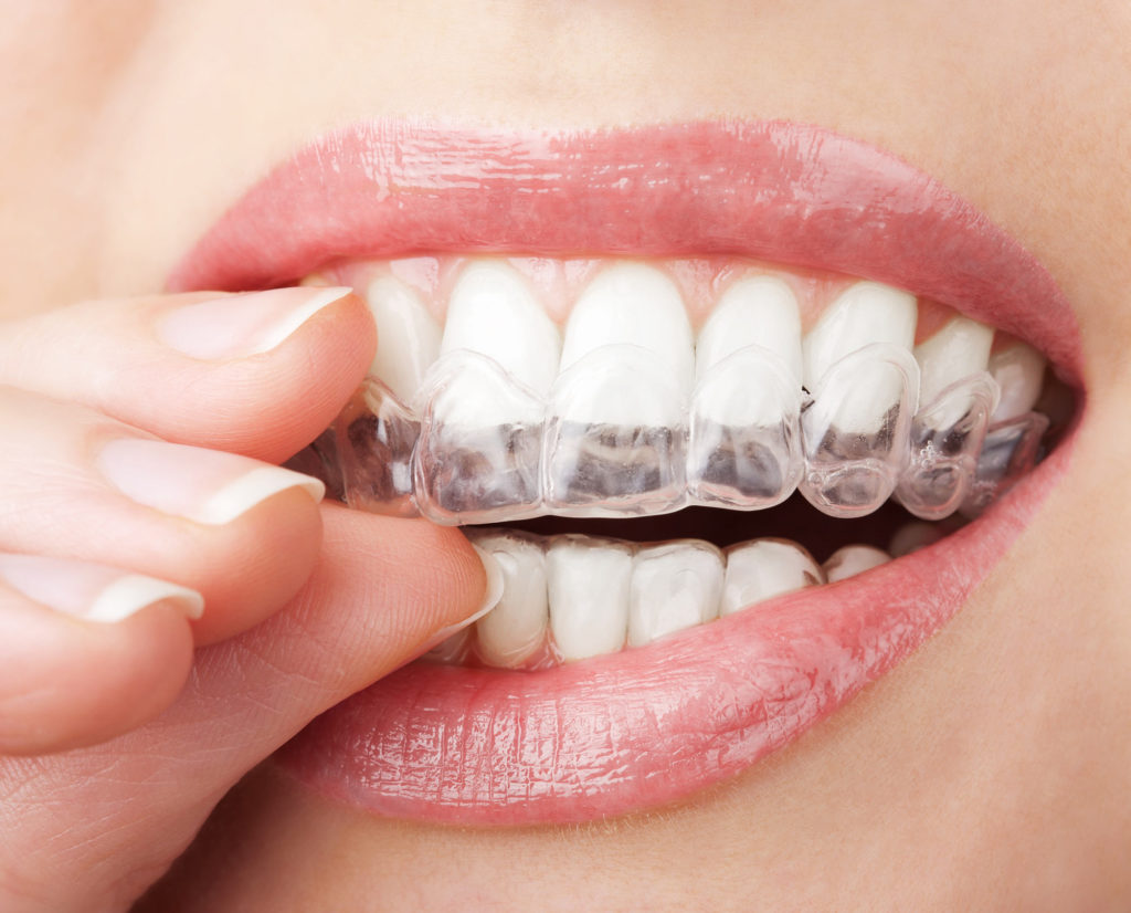 What Should I Do With All Of My Old Invisalign Trays? - Walnut